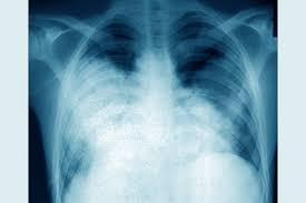Jul 02, 2009 · le pneumocoque est l'agent infectieux le plus fréquent et fait parti des deux germes les plus graves avec legionnella pneumophila (responsable de légionellose). Legionella Infektionen Durch Legionellen Infektionskrankheiten Msd Manual Profi Ausgabe
