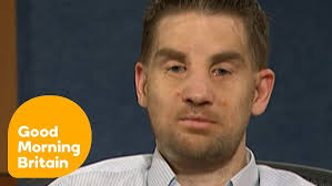 Face Transplant Recipient Meets Donor's Mother