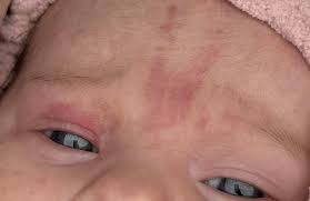 Image result for Nevus Simplex