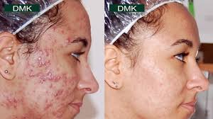 Dmk enzyme #1 stimulates fresh blood flow to the new tissue, bringing vital nutrients and deep enzyme therapy uses the beneficial effects of transfer messenger enzymes that work on the internal. Enzyme Therapy Evolve Private Aesthetics Clinic Bolton