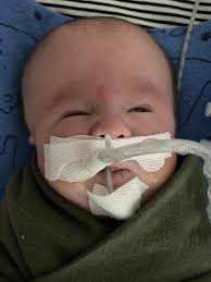 Intubated baby's behavior during blood transfusion
