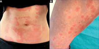 Check spelling or type a new query. Skin Manifestations Of Covid 19 Cleveland Clinic Journal Of Medicine