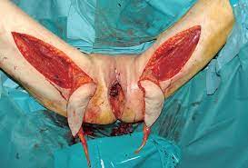 We did not find results for: Surgical Treatment Of Locally Advanced Anal Cancer After Male To Female Sex Reassignment Surgery