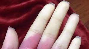 Disampaikan dokter spesialis paru richard russel, ia kerap memperhatikan kondisi tangan pasiennya ketika akan. Jemari Tangan Membiru Ketika Dingin Wanita Ini Terkena Penyakit Raynaud Health Liputan6 Com