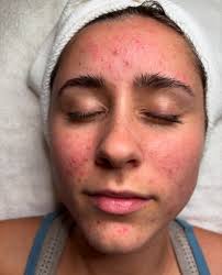 Emily Hansen Sessions (@emilysessions_skincare) • Instagram photos and  videos