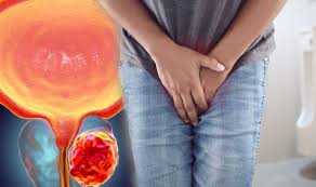 Local therapies with radical prostatectomy or radiation therapy are the two main ways to eliminate localized prostate cancer. Prostate Cancer Nocturia And Pain When Urinating Are Two Lesser Known Signs To Spot Sound Health And Lasting Wealth