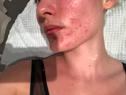 Disse jentene som deler bilder av huden fylt med kviser på instagram med #skinpositivity, er det man kan kalle en «skinfluencer». 5 Rutiner Som Har Forbedret Huden Min Marie Wolla