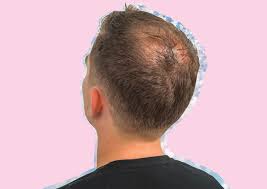 A small number of men have reported side effects taking finasteride, but that number seems to be less than 4%. Male Pattern Baldness Causes Prevention The Best Treatments Blog Huda Beauty