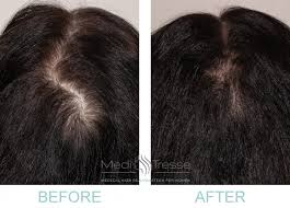 After 20 Years Of Thinning Hair One Woman Found Help In Wellesley