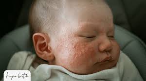 Image result for sweat rash on back baby