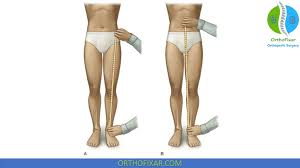 Image result for Functional Leg Length Discrepancy