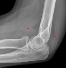 Image result for Elbow XRay