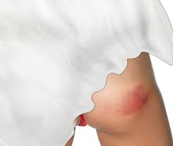 Everybody gets bruises at one time or another. Bruised Buttock Or Buttock Contusion Causes Signs Treatment Exercises