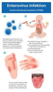 Both begin with the sort of muscle pain, fever, headaches, and nausea that you might see in response to any viral infection. Enterovirus Infektionen Enteroviren