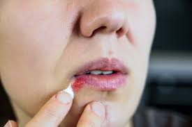 Docosanol shortens the healing time and the length of time symptoms are present. Abreva Cream Cold Sore Medicine Abreva