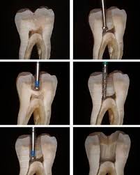 Endodontics Australian Toothteeth Specialty Rootcanal Accessing Instagram Teethfaq Chamber Dentist Anatomy Posted Zahnheilkunde Zahne Zahnmedizin