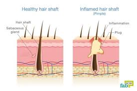 How To Treat Folliculitis Foliculitis Treatment Hair Follicle Treatment Hair Follicle