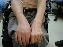 Swelling often occurs at the site of the blood clot in the body. Can You Get A Dvt In Your Arm Scary Symptoms
