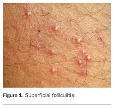 Image result for Deep Folliculitis