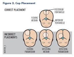 Image result for Vacuum Caput