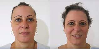 Weight loss, alcohol intolerance, cushing's syndrome, gout, abnormal healing, and. Alopecia Areata Testimonials Coimbra Protocol This Is Ms Multiple Sclerosis Knowledge Support Community