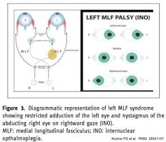 Image result for Neurologic Lesion Localization