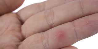 The Best Way To Remove A Splinter Men S Health