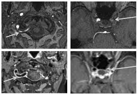 Entzundung Oder Infarkt Vessel Wall Imaging Hilft Bei Der Klarung Healthcare In Europe Com