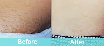 Immediately after bikini line laser hair removal, your laser technician will apply a soothing aloe vera gel to calm the treated area. Bikini Line Laser Hair Removal Hair Removal Prettylasers