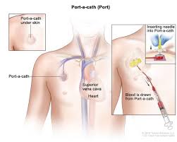 Definition Of Port Nci Dictionary Of Cancer Terms National Cancer Institute