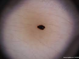 Image result for Spitz Nevus
