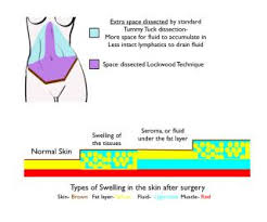 Maybe you would like to learn more about one of these? How To Control Postoperative Swelling After Tummy Tuck Cosmeticsurg