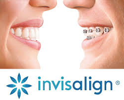 No repairs required sometimes a bracket or wire may become loose with traditional braces, which means yet another orthodontist visit. Invisalign Okc Invisalign And Clear Braces Treatment Oklahoma