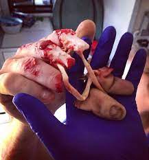 40 Best Degloved Images On Pholder Medizzy Sfx And Natureismetal