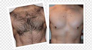 Many people say laser hair removal feels like tiny pinpricks. Laser Hair Removal Patty Gourgaris Laser Skin Studio Waxing Laser Hair Removal Face Arm Abdomen Png Pngwing