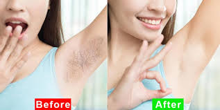 permanent hair removal creams