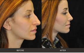 We did not find results for: Best Rhinoplasty Nose Surgery Beverly Hills Los Angeles West Hollywood Ca