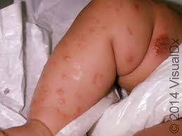 Image result for scabies human children