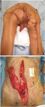 Informative str markers for marfan syndrome in birjand, iran. Severe Fournier S Gangrene In A Patient With Rectal Cancer Case Report And Literature Review World Journal Of Surgical Oncology Full Text