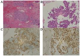 The only way doctors can conclusively diagnose mesothelioma tumors is to perform a tissue biopsy and have a pathologist examine the sample under a microscope. Membranous Nephropathy Associated With Malignant Pleural Mesothelioma In An Adult Patient A Case Report