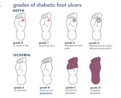 Image result for IDSA Diabetic Foot Wound Classification