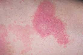 Thyroid cancer develops when cells change or mutate. 4 Possible Causes Of Hives That Will Surprise You