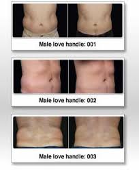 Pin On Coolsculpting Complete Center Of Raleigh