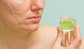 Lidah buaya (aloe vera) adalah spesies tumbuhan dengan daun berdaging tebal dari genus aloe. Step By Step Penyembuhan Jerawat Pakai Lidah Buaya Realistis Dan Gampang Banget