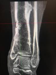 Image result for Osteomyelitis Bone Scan