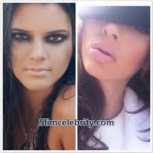 Kendall Jenner Lip Injections Photos Kendall Jenner Lip Injections Lip Injections Juvederm Lips