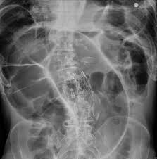 Image result for Sigmoid Volvulus