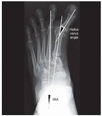 Image result for Hallux Varus