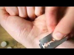 إصلاح الأوتار المقطوعه بالجراحة tendon injury repair. Ù…Ù† ÙØ¶Ù„Ùƒ Ø§Ø¯Ø®Ù„ÙŠ Ø´ÙˆÙÙŠ ÙˆÙ„Ø§Ø¯Ùƒ Ù…Ø¹Ø±Ø¶ÙŠÙ† Ù„Ø£ÙŠÙ‡ ÙƒØ§ØªÙŠÙ†Ø¬ Youtube
