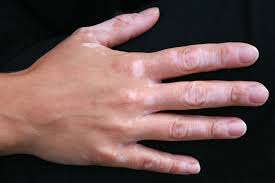 The areas of skin most commonly affected by vitiligo include Vitiligo Definition Facts Britannica